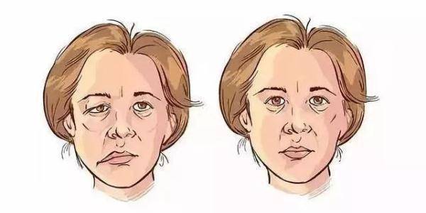 面部|天冷易诱发面瘫，这些症状要注意！