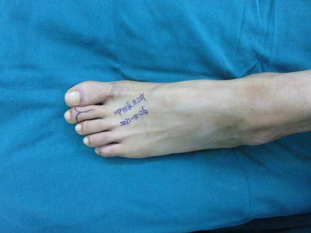 小伙|小伙3指离断19小时千里奔广州，“再植＋再造”成功保指