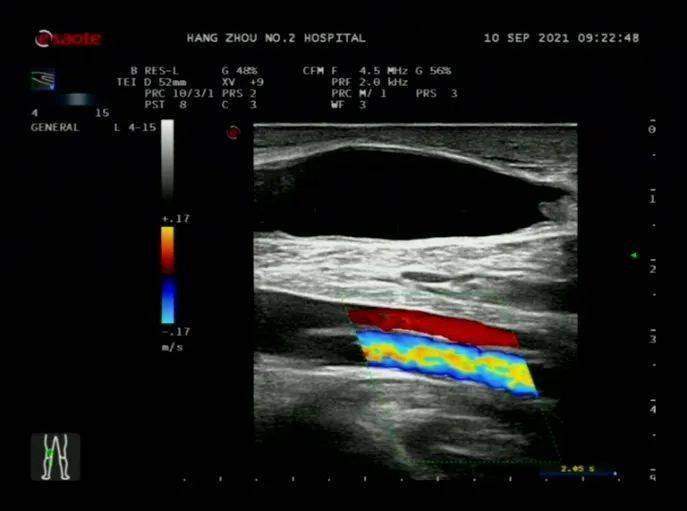 图 19 腘窝囊肿图片来源:作者提供图 20 腘窝囊肿图片来源:作者提供