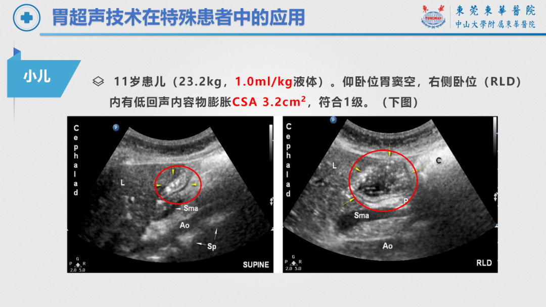 正常胃的超声图像图片