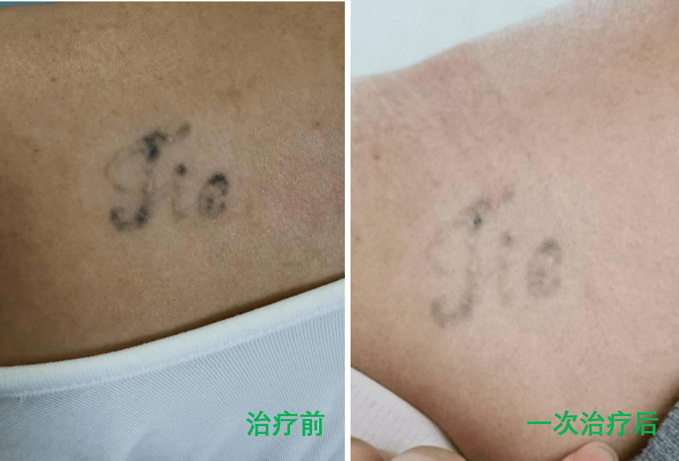 此外,雀斑样痣,颧部褐青色痣,蒙古斑,伊藤痣也是常见的色素增加性皮肤