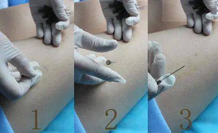 机体|【医文医话】针灸二科：带您了解穴位埋线疗法