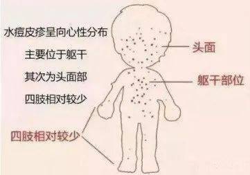 水痘高发季,家长别大意!