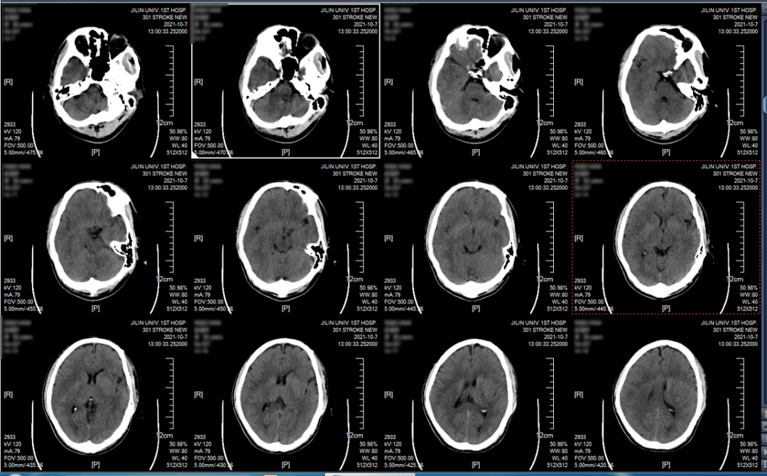 脑部ct结果图图片