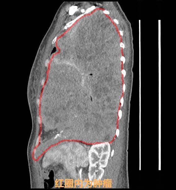 女子|年轻女子胸腔长了个大西瓜般肿瘤，还好巨瘤介于良恶性边缘