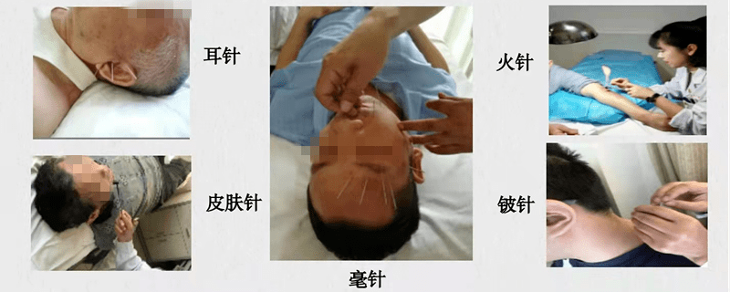 技术|【义诊通知】医院11月22日举办“世界针灸日”义诊活动