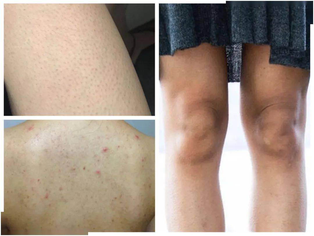 全身刷酸鸡皮肤治疗(身体刷酸后鸡皮肤更严重了)