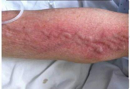 输液外渗的护理方法,你会用得到!