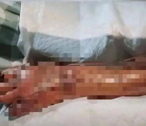 伤口处|吃海鲜前这件事千万要注意！广东大爷被迫截肢……