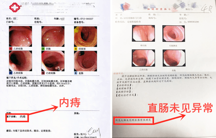 痔疮病历单图片图片