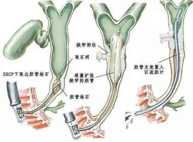 在ercp的基礎上,可以進行十二指腸乳頭括約肌切開術(est),內鏡下鼻