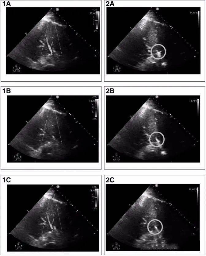 扩展肺部超声鉴别重症患者肺炎和肺不张的诊断准确性研究