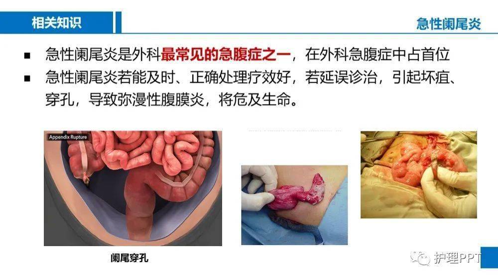 急性化脓性阑尾炎护理查房