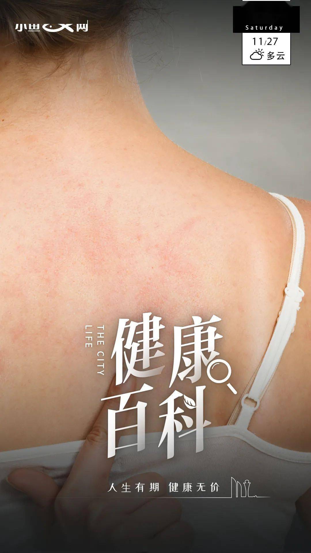 孩子大病后又常得荨麻疹就推迟了疫苗接种结果不让上学了关于荨麻疹
