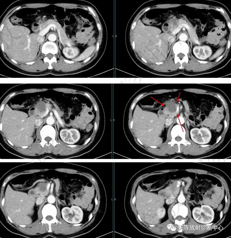 罕见病胰腺腺泡细胞癌