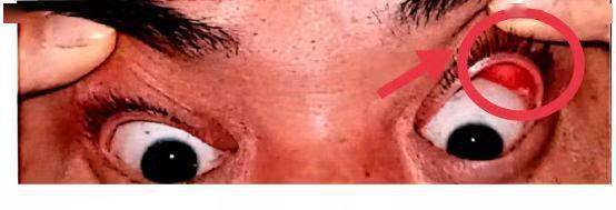 眼眶|眼眶里面长肿瘤，广州男子莫名流泪两年