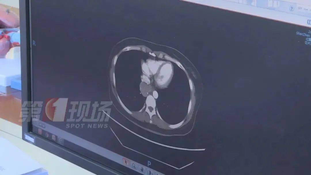 肿瘤|一女子手指肿成“萝卜头”，一查竟是癌症！务必警惕身体这些信号