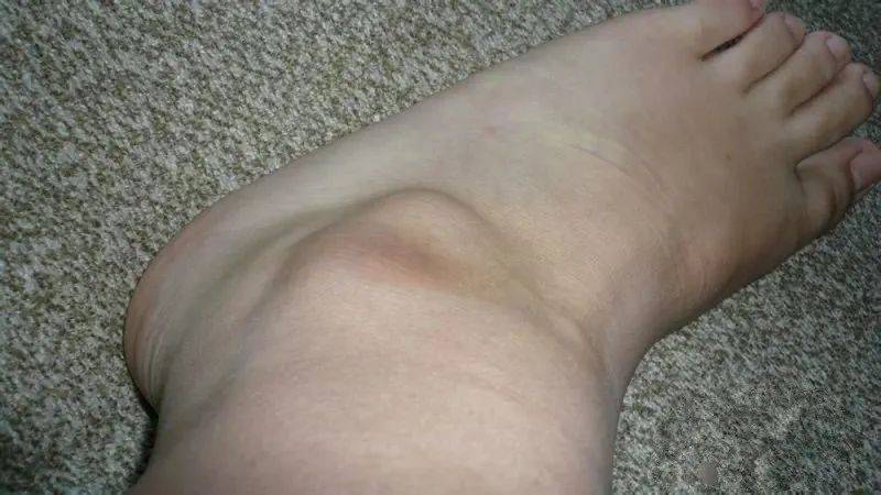 不手术,外洗(针刺)消腱鞘炎/腱鞘囊肿于无形_闫夫人_治疗_肿块