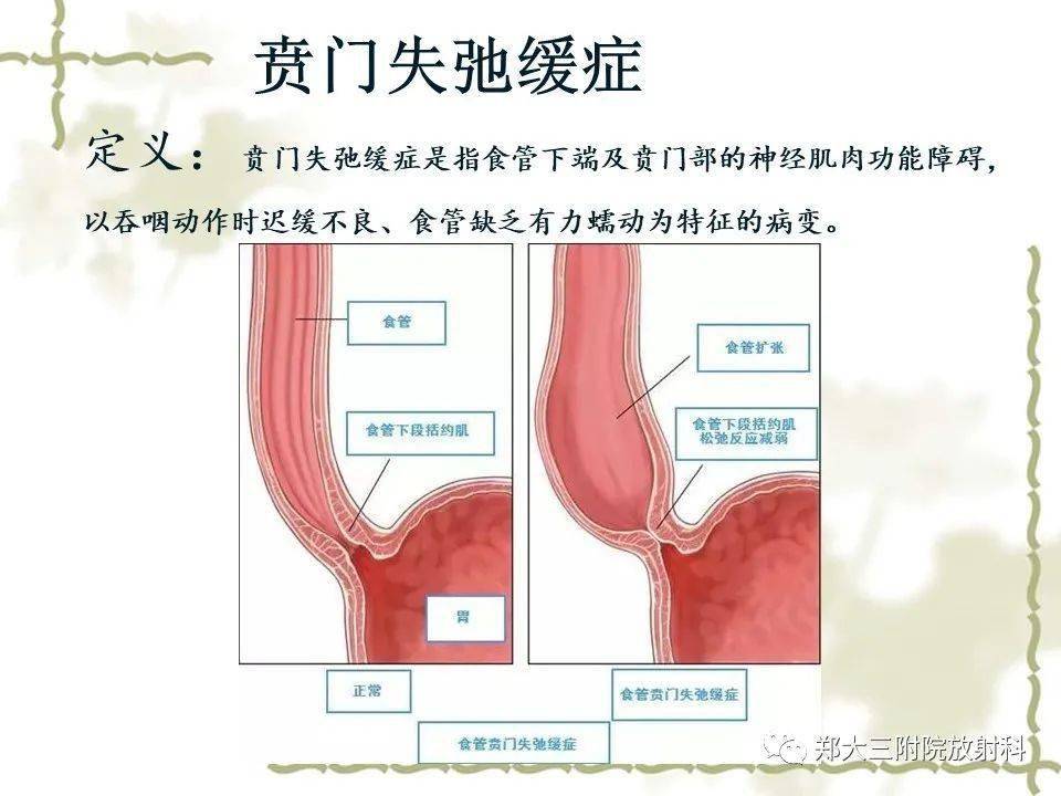 贲门失弛缓症的影像诊断