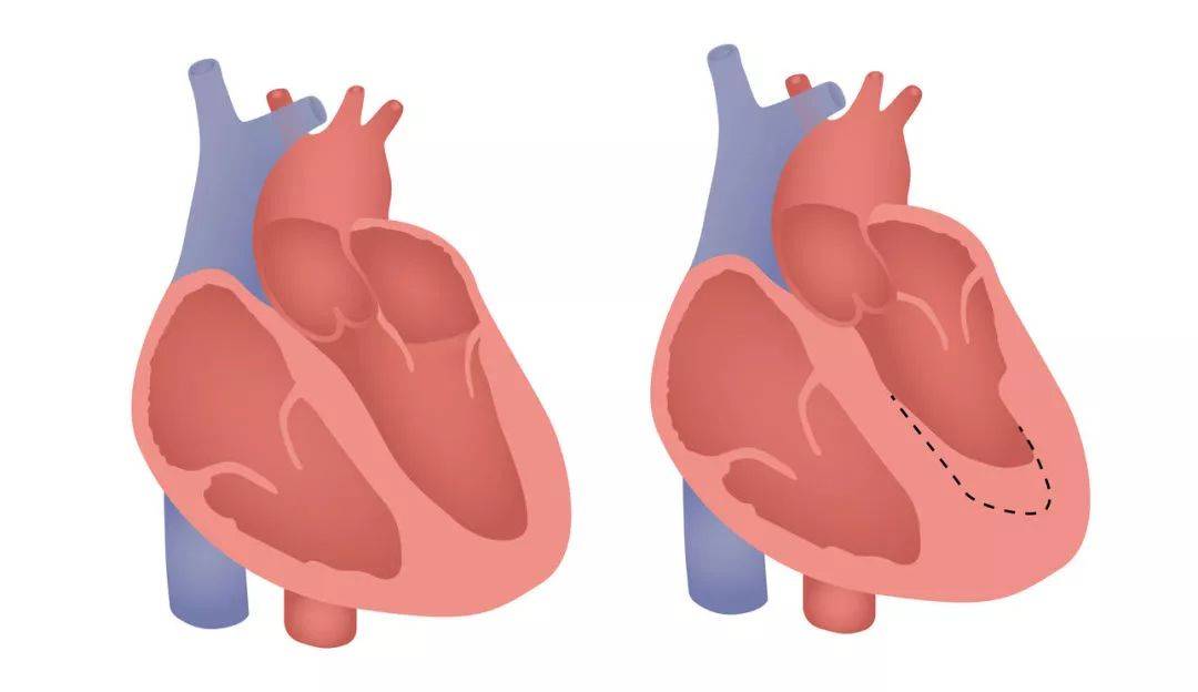 心脏增大心脏功能强大心脏彩超中的这几个词要注意