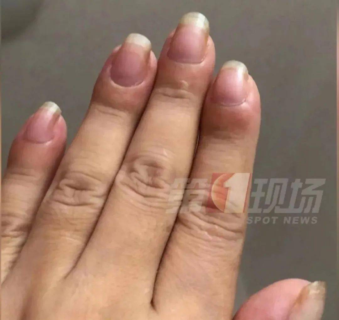 编者按手指肿胀,竟被查出了癌症?1手指肿胀,竟被查出了癌症?