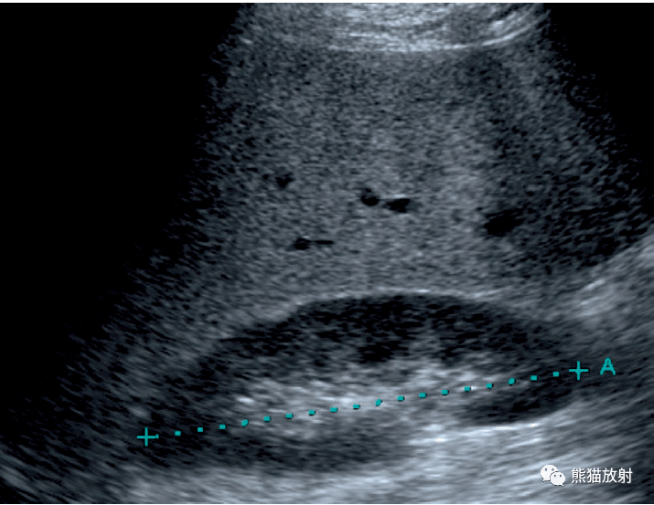 脂肪肝时超声显示肝实质回声增强,使得门静脉边缘模糊不清(图)