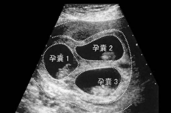 郑州一女子怀上八胞胎,怎么怀上的?这些胎儿都能保住吗?