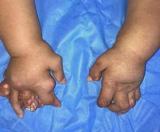 看着都痛男子长出一对生姜手只因爱吃