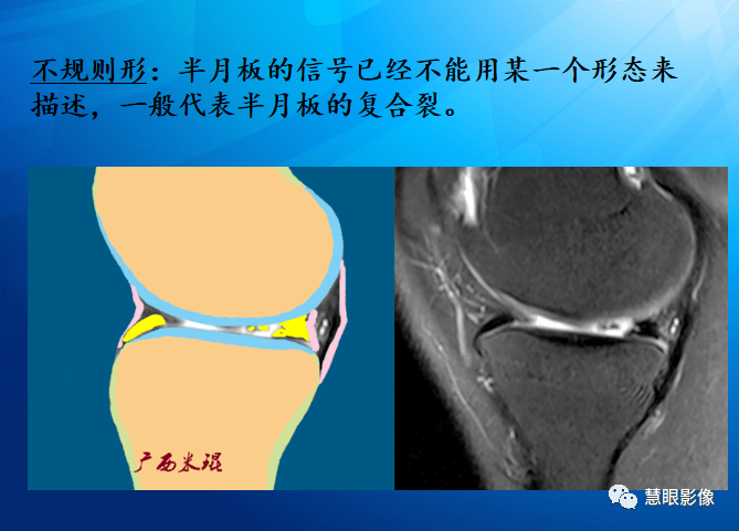 mri半月板損傷基礎