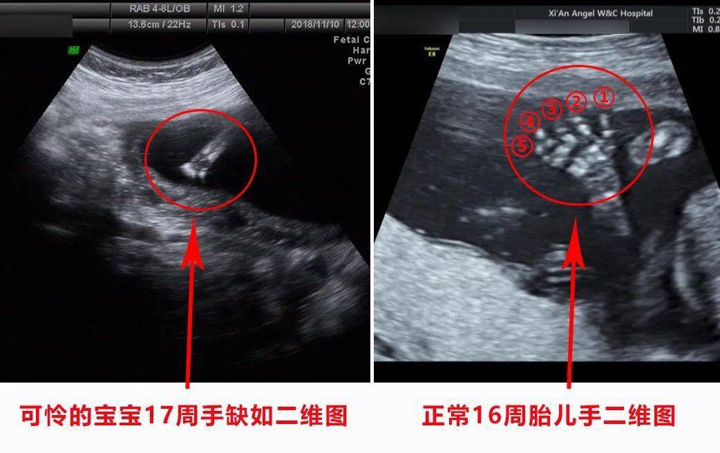 【大咖科普】四維,三維,二維超聲有什麼區別?傳說中的