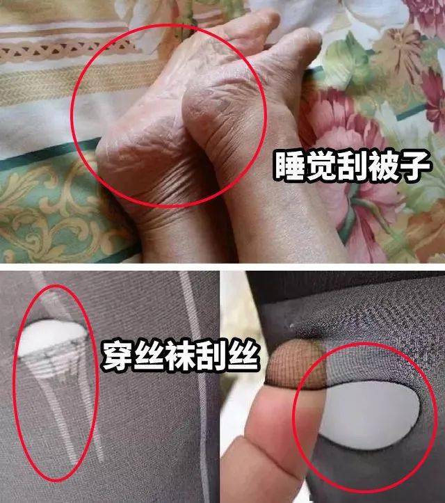 草本植物脚跟开裂、老茧、死皮……又疼又丑！用它一抹，双脚嫩滑，实测惊呆了！