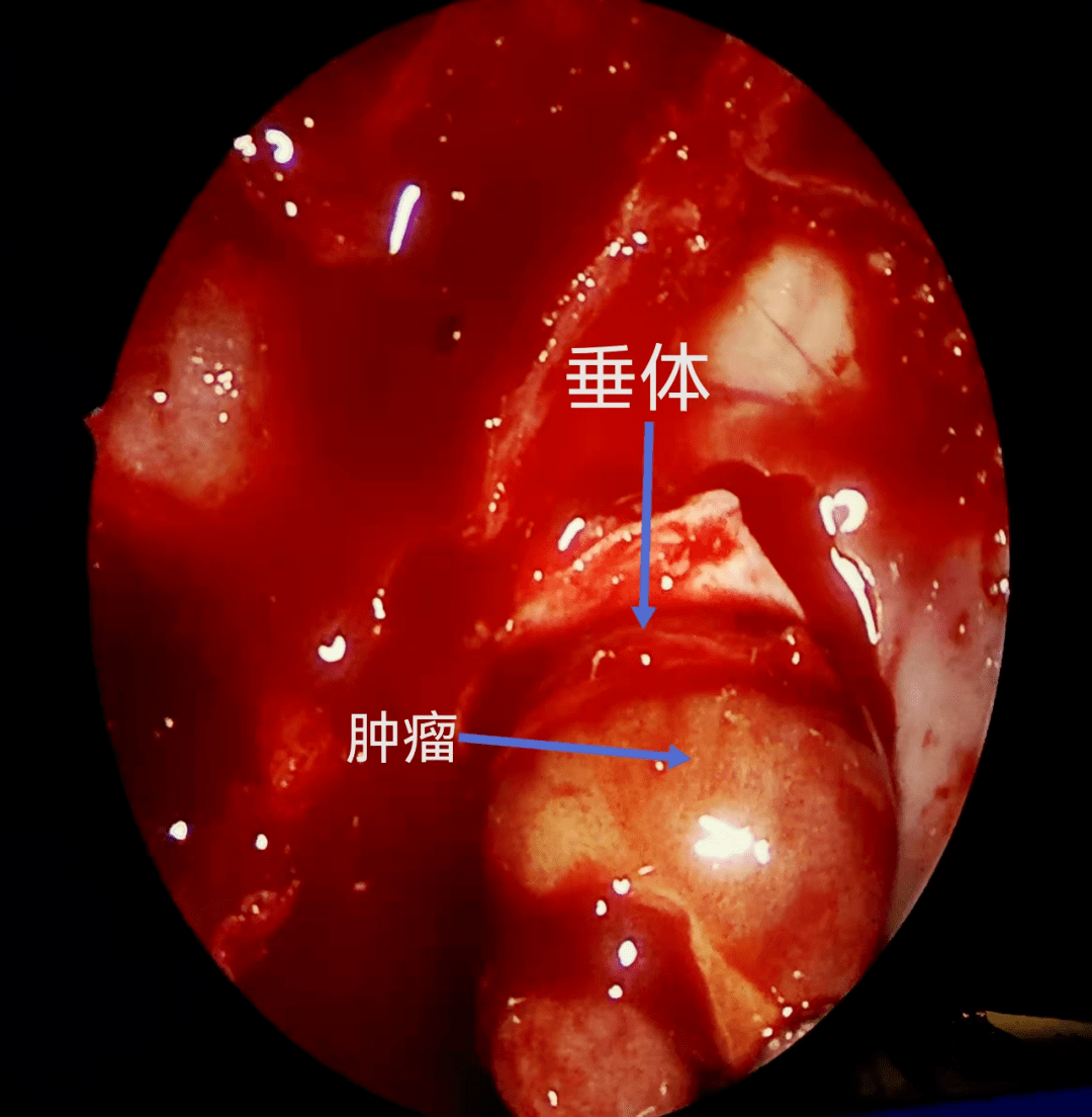 王兵副教授内镜经鼻切除垂体瘤相关技术小结游学意大利十三