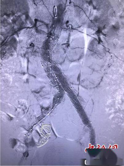 手术|患者术前反复发烧 医生“抽丝剥茧”发现极罕见病例