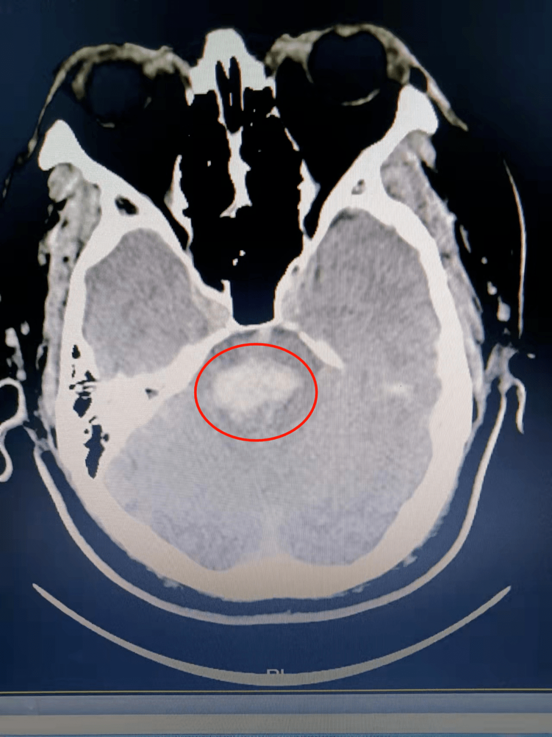 脑干出血ct图片