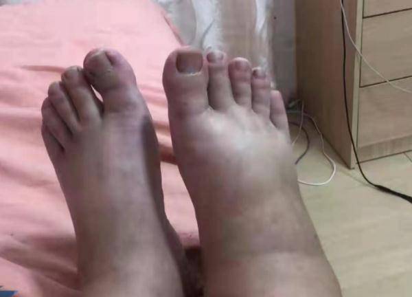 广东|每天喝十几瓶啤酒，广东一男子体内抽出“牛奶”