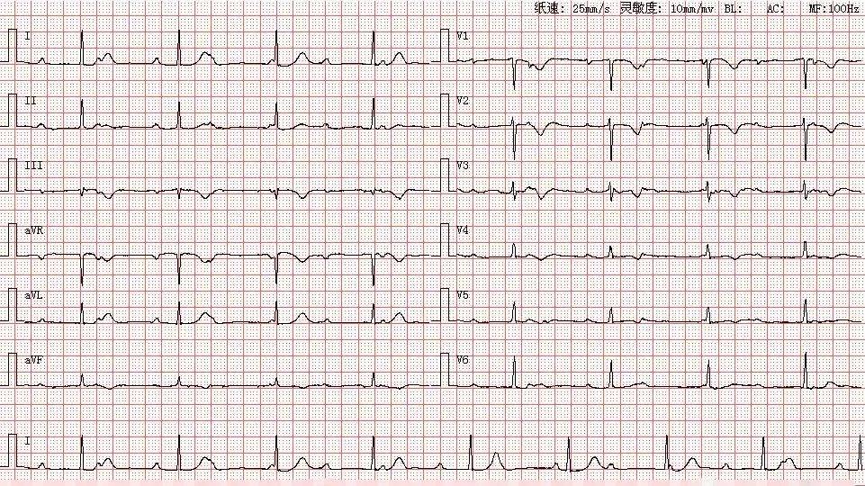 心电图库丨三度房室传导阻滞系列_心律_窦性_患者