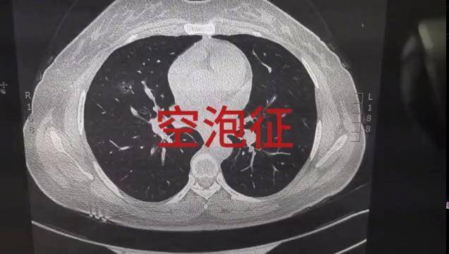 肺结节或肿瘤常见征象之空泡征