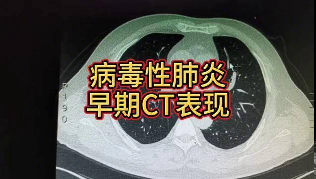 從一例確診病例上了解早期病毒性肺炎ct影像學表現特點