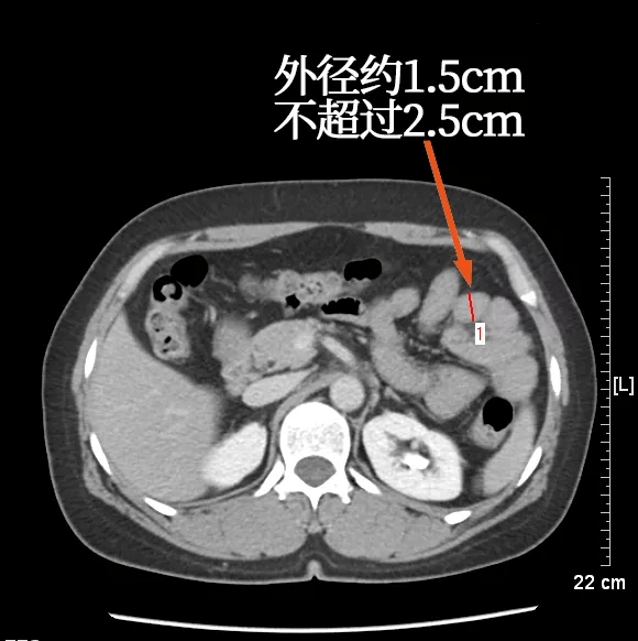 肠系膜根部ct解剖图图片