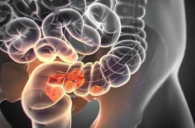 降低|食品安全｜咸菜、腊肉不能吃？会致癌？要想吃得放心，牢记这4点…