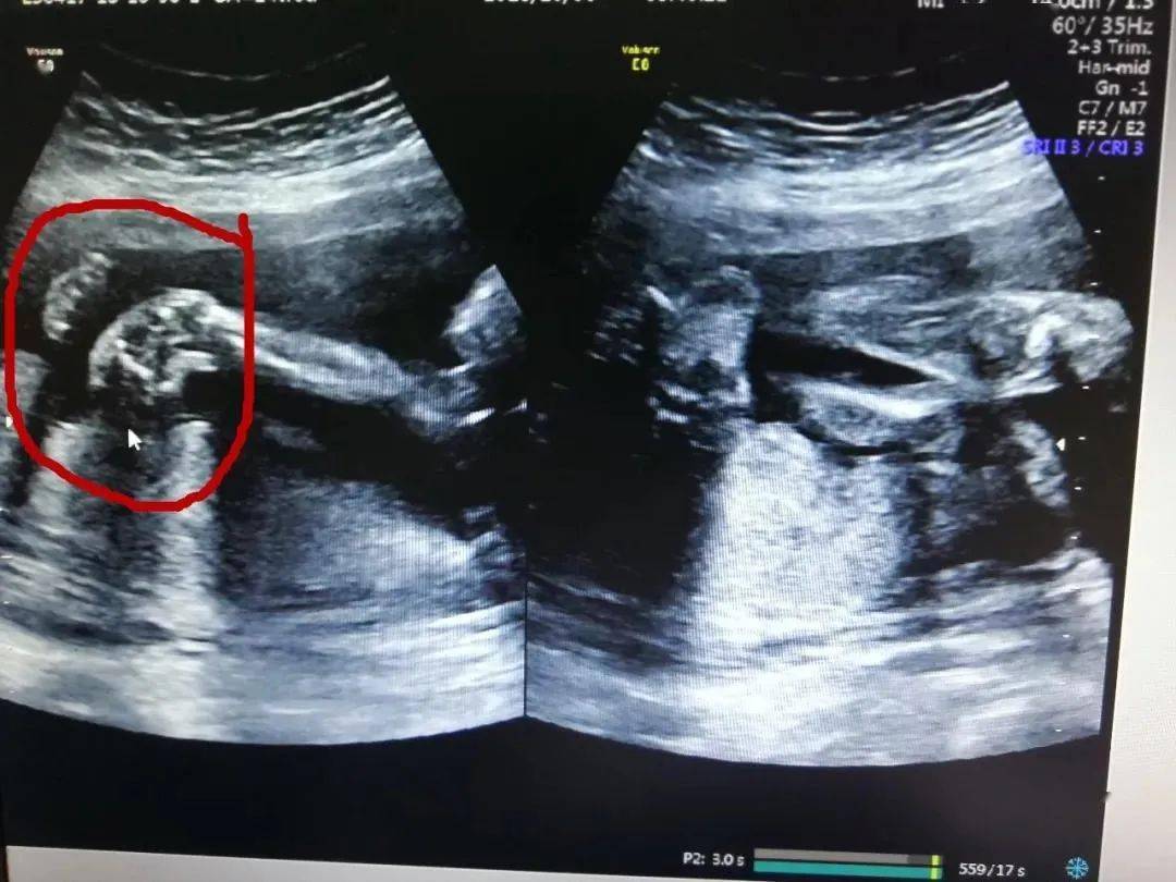 男胎儿的四维彩超图片图片