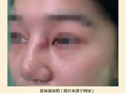 什么法令纹消失术？亲测有效！