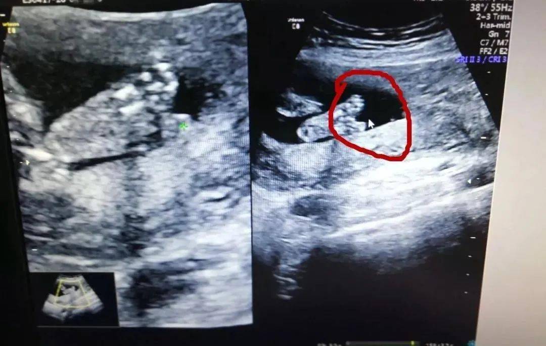 胎儿24周四维彩超图图片