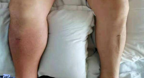 mol|每天喝十几瓶啤酒，一男子体内抽出“牛奶”