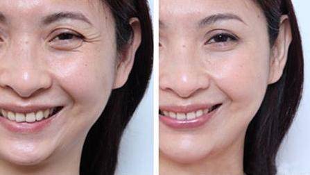 开眼角显老吗 701c48bc562b4d378bdfa6ec375ee053.jpeg