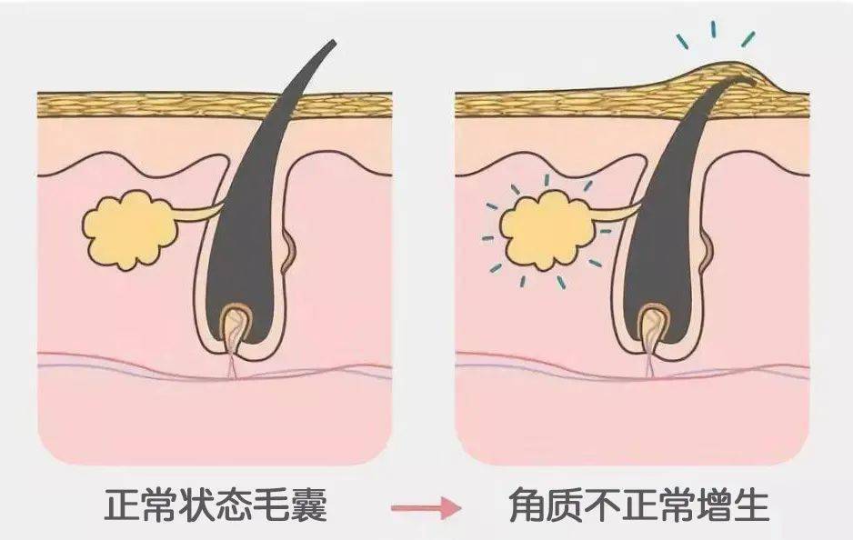 毛周「鸡皮肤」患者自救指南 !还你光滑肌肤