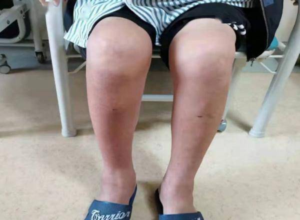 mol|每天喝十几瓶啤酒，一男子体内抽出“牛奶”