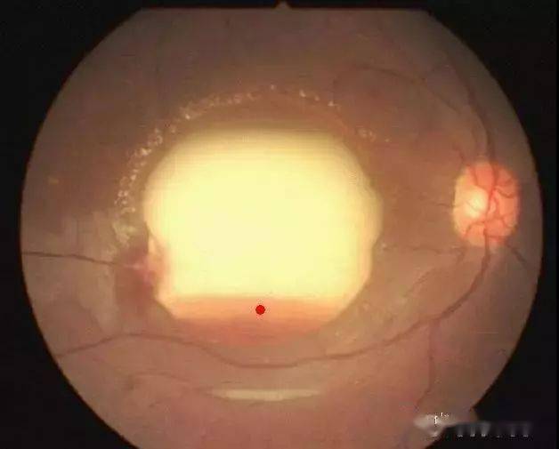 常见眼科病例的眼底照片集锦