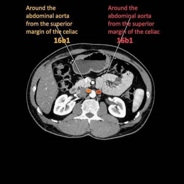 胰腺癌的ct诊断书图片图片