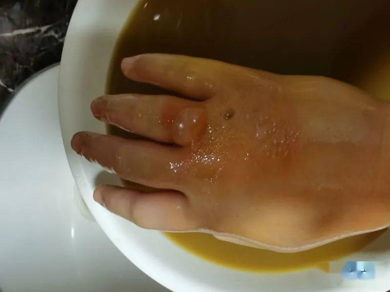 泉州人注意:冬天晾晒衣物要当心_马蜂_衣服_伤口